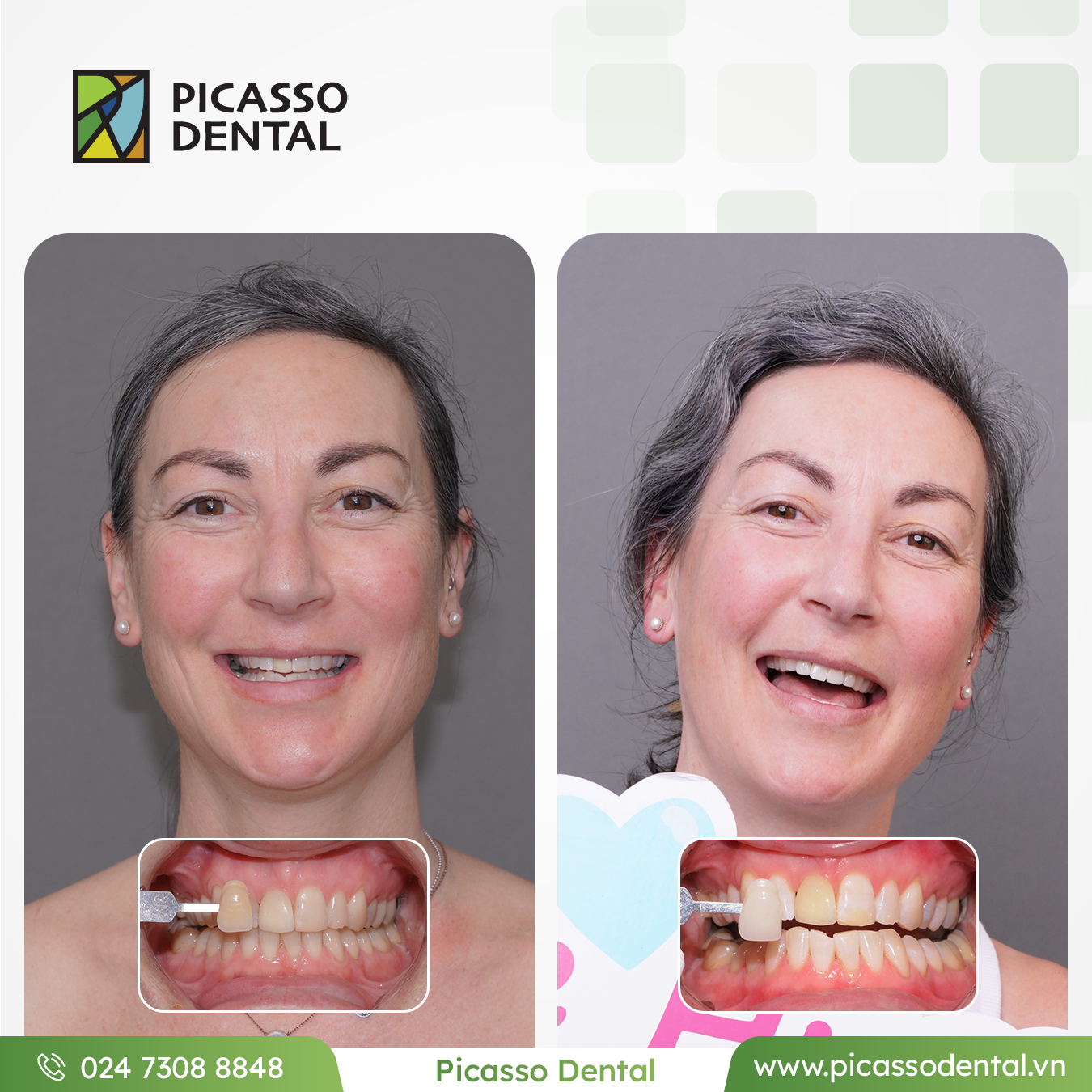 သွားအာရုံကြောကုသမှု (Root Canal) ကုသမှုရလဒ် — ပီကာဆို ဒင်တယ်